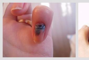 Травма ногтевой пластины