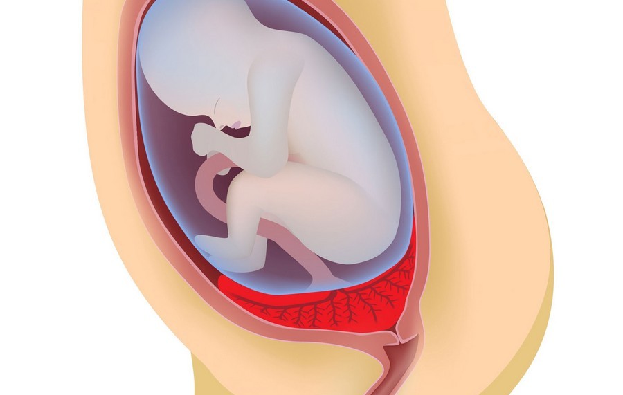 The consequences of placental abruption for the fetus - the opinion of the doctor
